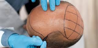 FUE hair transplant